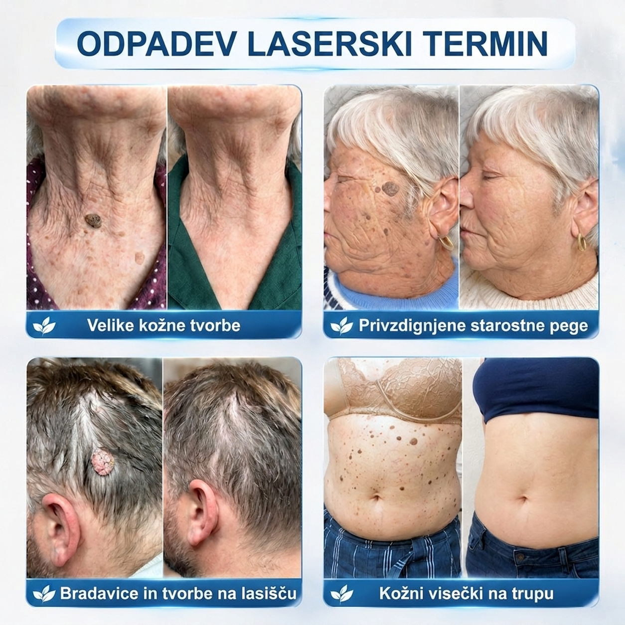 🌿PuraCure®👩‍⚕️ Rezultati so vidni že v 7 dneh! Valjček za odstranjevanje bradavic in drugih kožnih težav | Neboleče in minimalno razmaže.