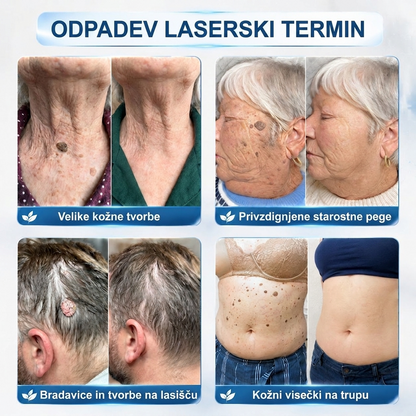 🌿PuraCure®👩‍⚕️ Rezultati so vidni že v 7 dneh! Valjček za odstranjevanje bradavic in drugih kožnih težav | Neboleče in minimalno razmaže.