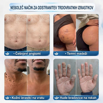 🌿PuraCure®👩‍⚕️ Rezultati so vidni že v 7 dneh! Valjček za odstranjevanje bradavic in drugih kožnih težav | Neboleče in minimalno razmaže.