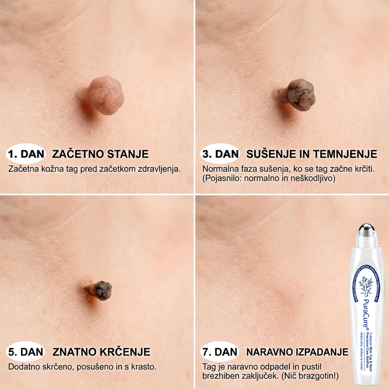🌿PuraCure®👩‍⚕️ Rezultati so vidni že v 7 dneh! Valjček za odstranjevanje bradavic in drugih kožnih težav | Neboleče in minimalno razmaže.