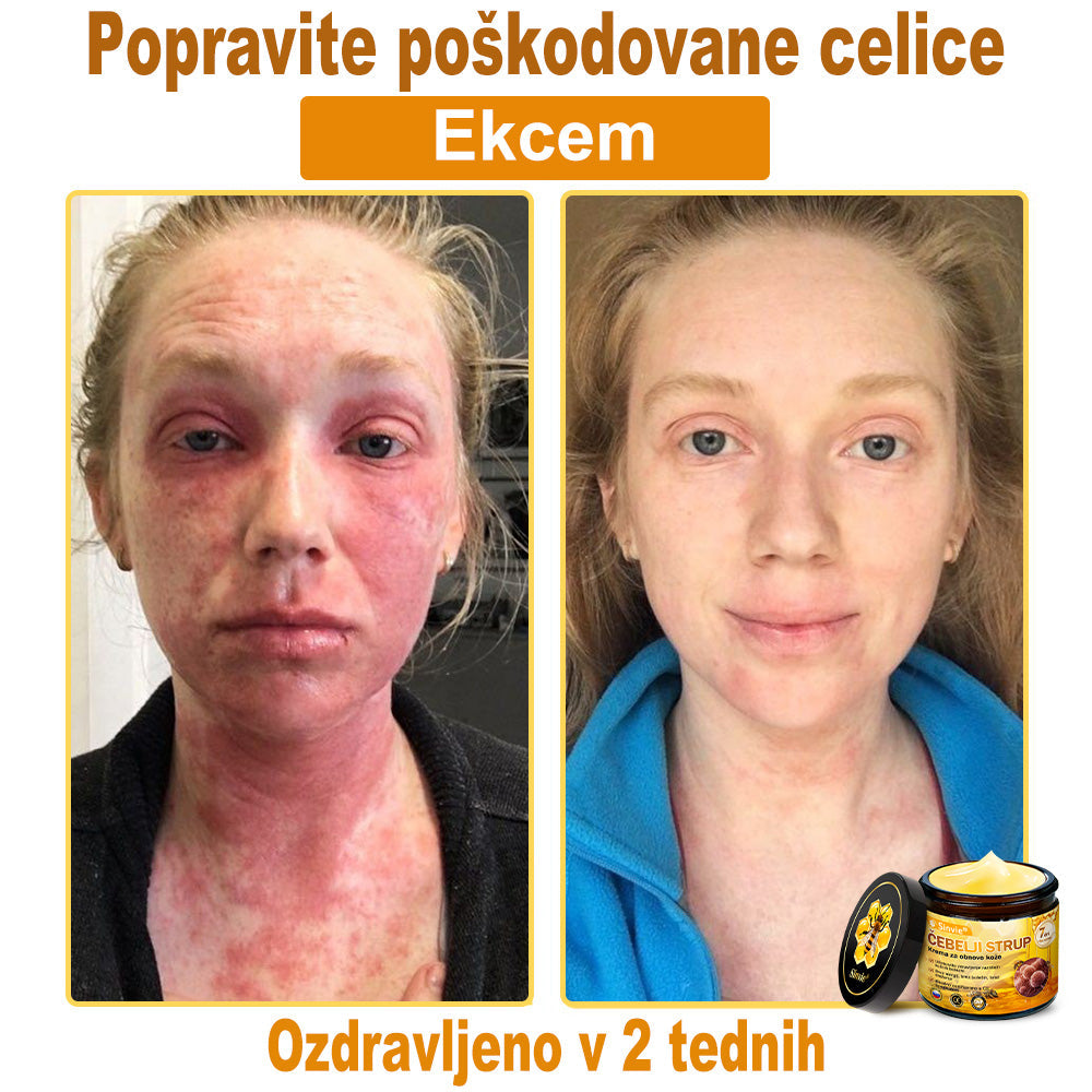 🌿🌿👨‍⚕Sinvie® Krema za obnovo kože z čebeljim strupom | 50 ml | Priporočeno dermatologov